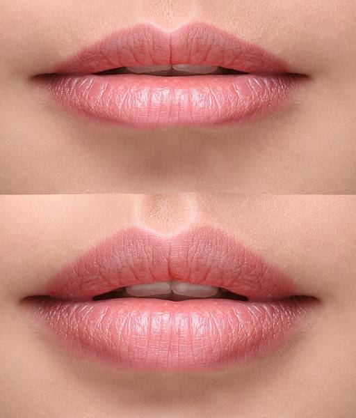 Finding the Right Lip Filler Specialist Near You