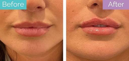 lip filler before and after 1