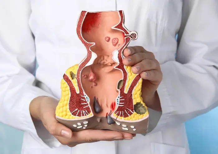 5 Things to Remember Before Hemorrhoid Treatment in Foxhurst, South Bronx, NY Hemorrhoid Treatment in Foxhurst, South Bronx, NY