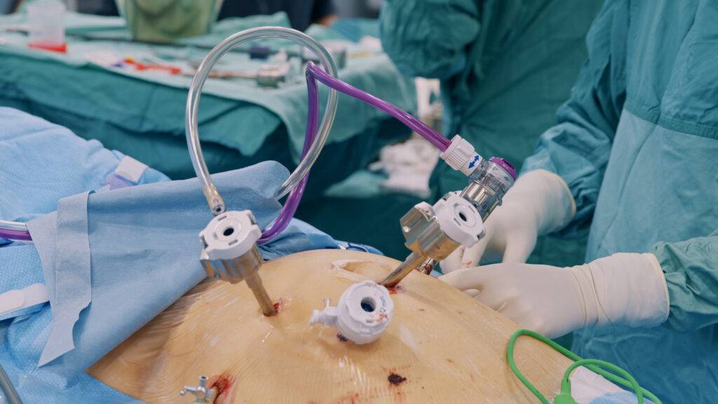 How Laparoscopic Surgery Improves Postoperative Outcomes in Melbourne s2 1024x576 1