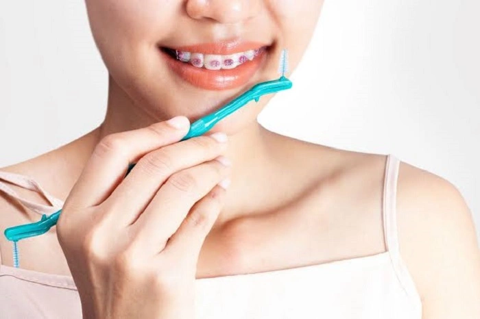 Hints and tricks to prevent stains during orthodontic treatment