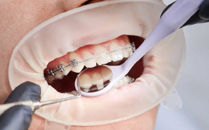 How to Whiten Your Teeth With Braces Safely: Best Tips & Methods how to whiten your teeth with braces